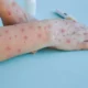 Monkeypox Symptoms: Dos and Don'ts if You Are Diagnosed with This Viral Disease